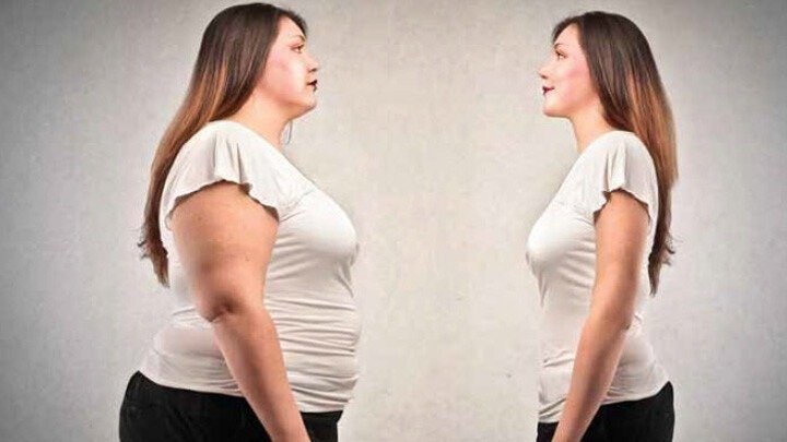 Morbid Obezite Tedavisinde Bariatrik Cerrahi Uygulamaları